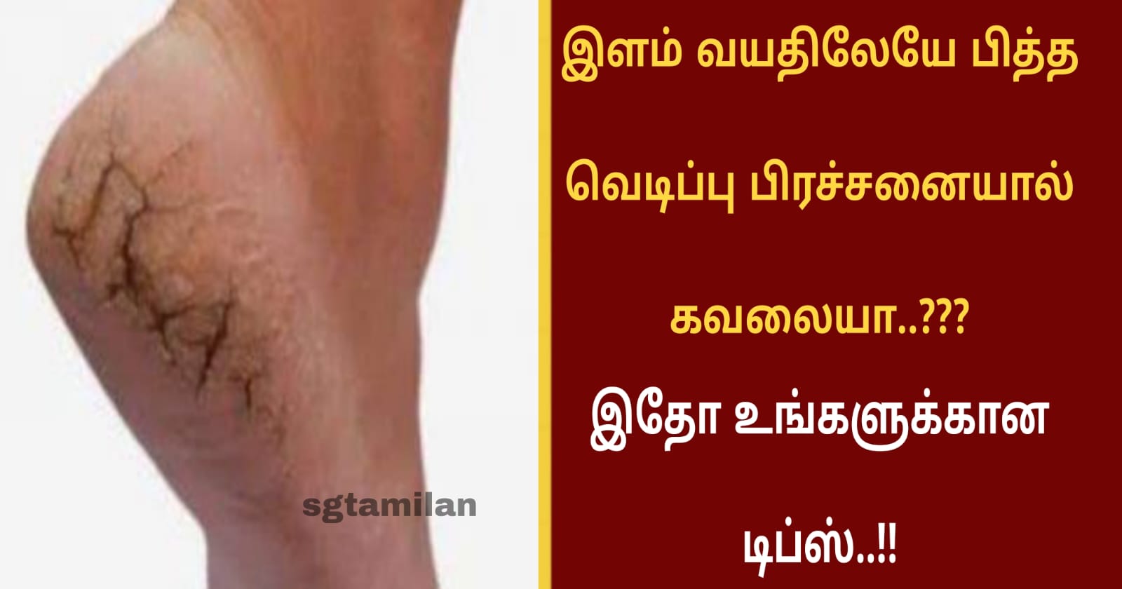 இளம் வயதிலேயே பித்த வெடிப்பு பிரச்சனையால் கவலையா..??? இதோ உங்களுக்கான டிப்ஸ்..!!