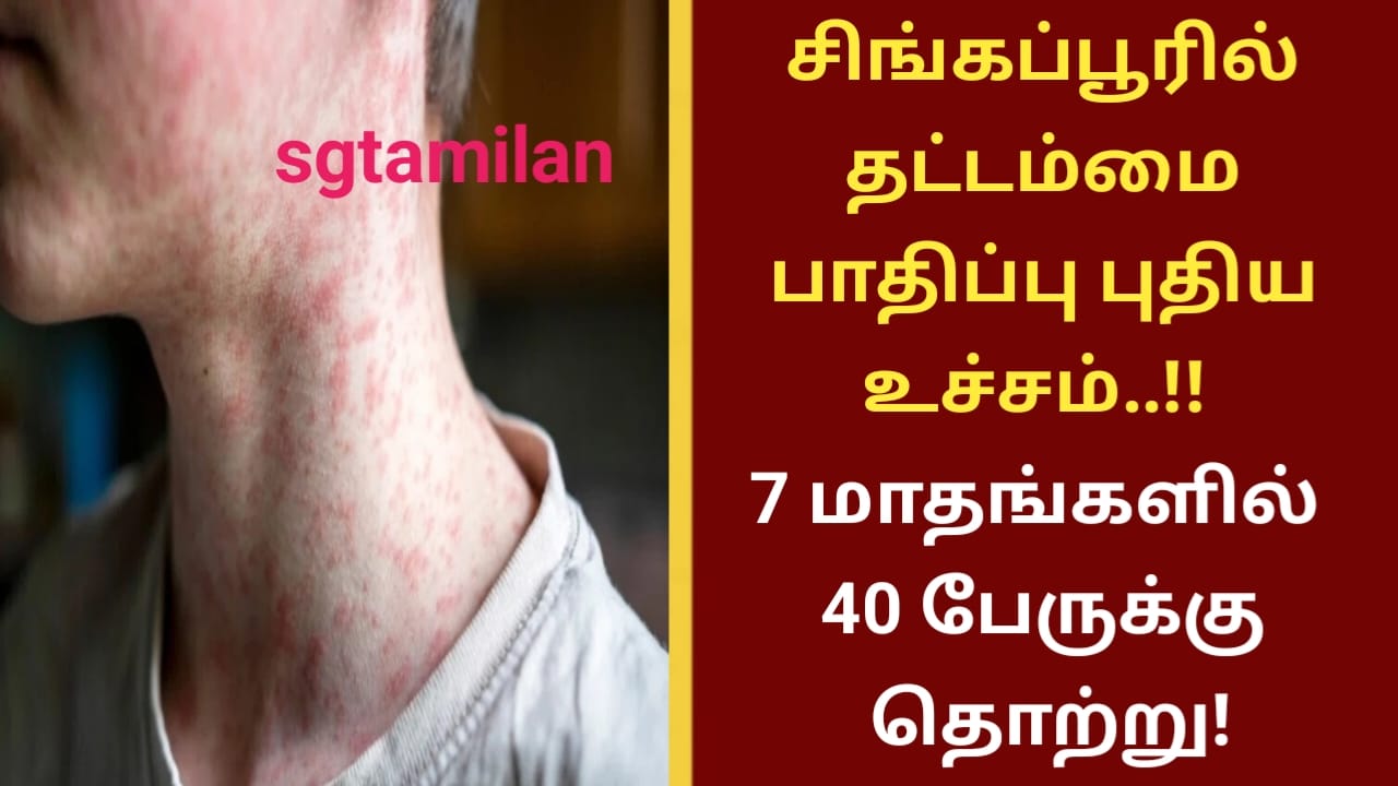சிங்கப்பூரில் தட்டம்மை பாதிப்பு புதிய உச்சம்..!! 7 மாதங்களில் 40 பேருக்கு தொற்று!